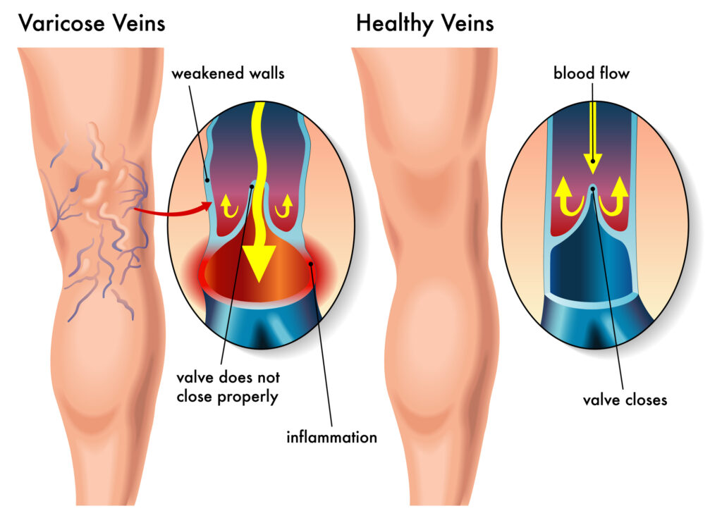 varicose veins versus healthy veins