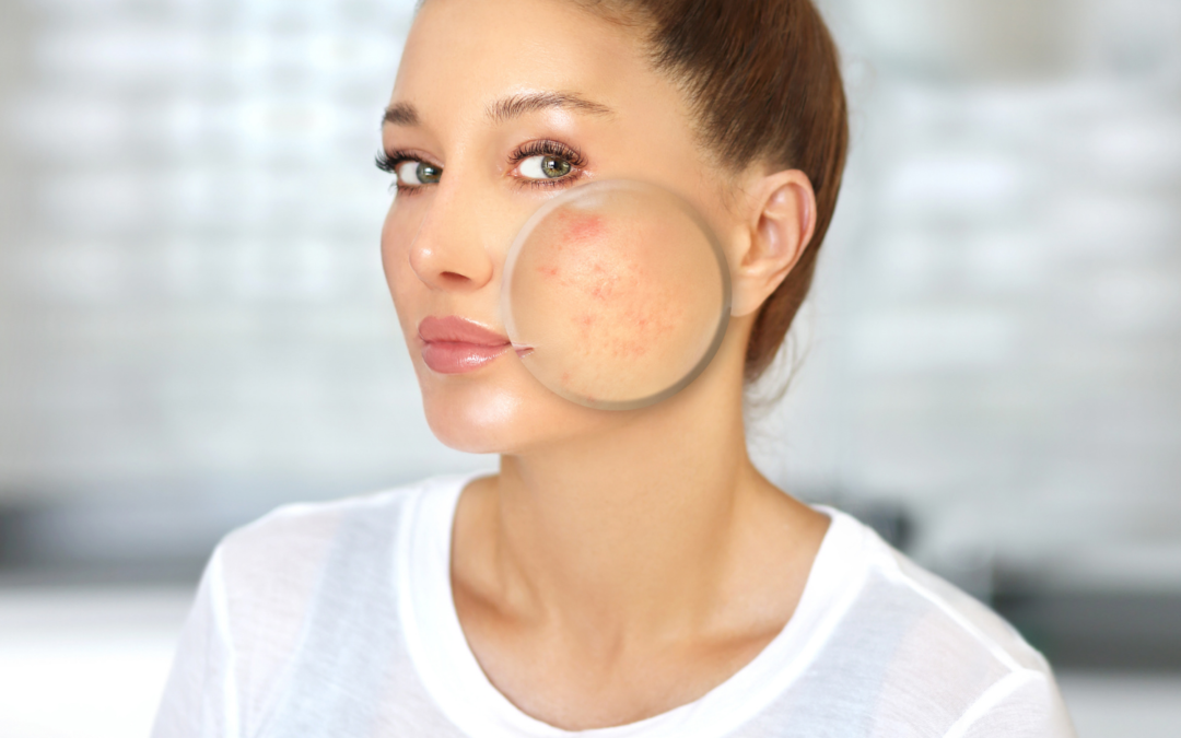 Get Rid Of Acne Scars With These Natural Home Remedies