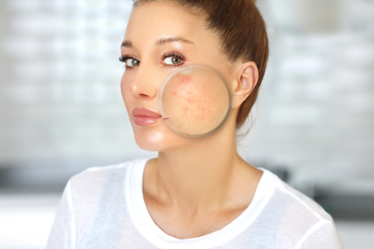 get-rid-of-acne-scars-with-these-natural-home-remedies