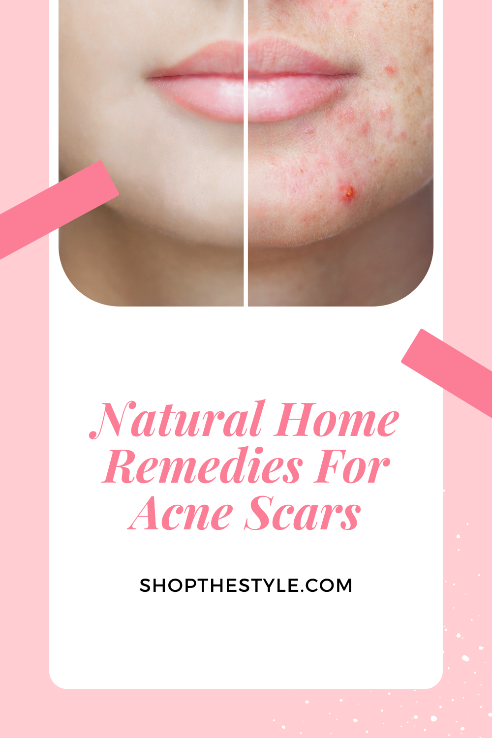 Natural Home Remedies For Acne Scars