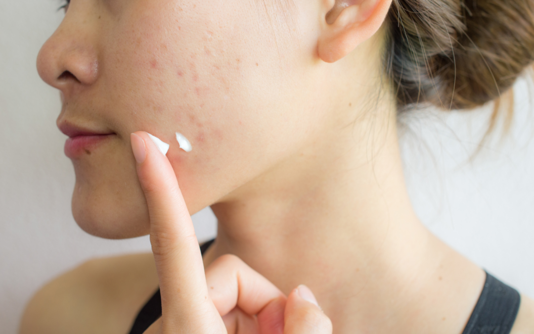 How To Get Rid Of Pimples, Blackheads And Other Forms Of Acne