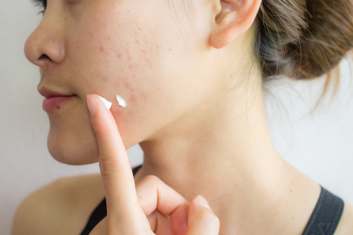 How To Get Rid Of Pimples Blackheads And Other Forms Of Acne Shop 