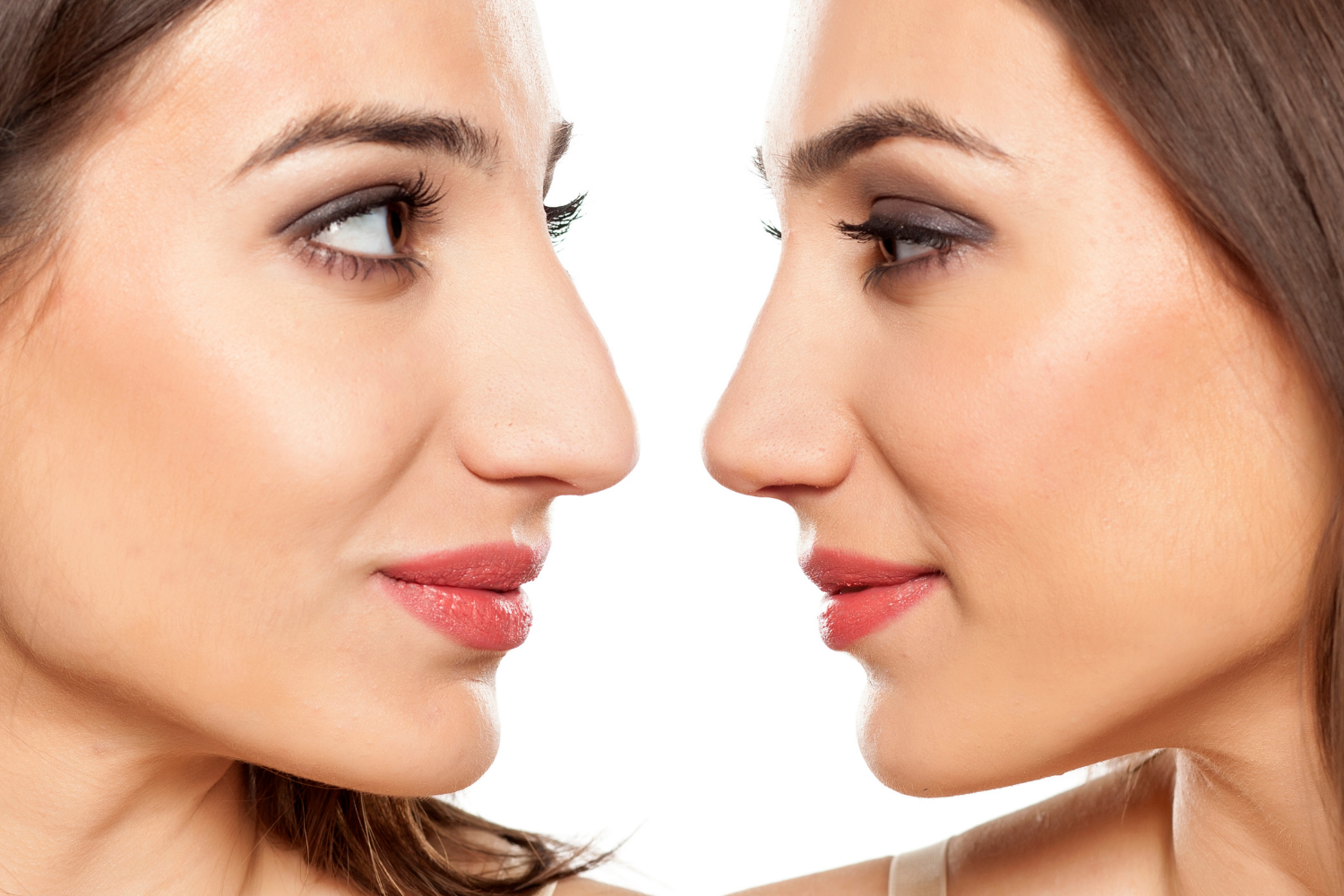 Rhinoplasty Surgery before and after pics